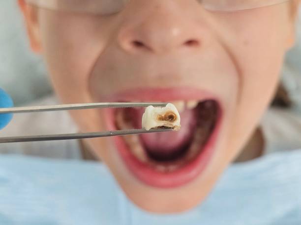 Best Emergency Wisdom Teeth Removal in Sturgis, MI